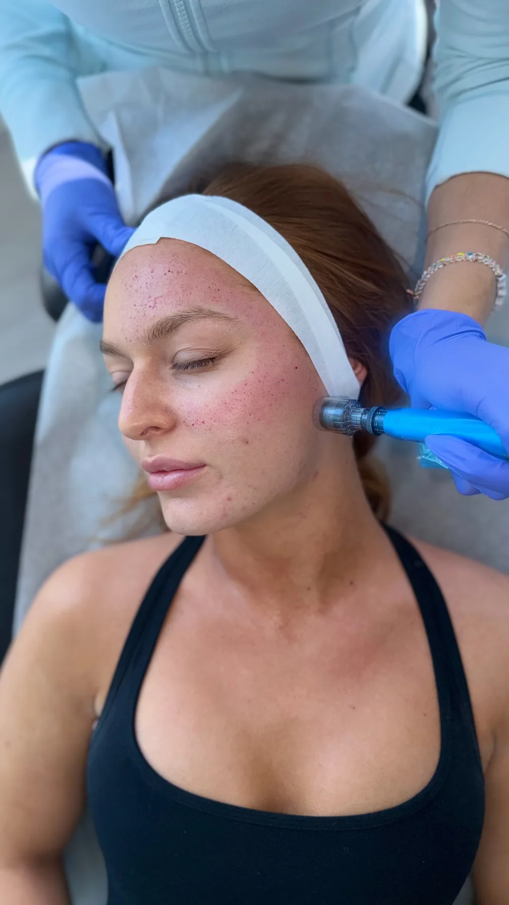 Professional microneedling procedure performed with gloved hands in a treatment room